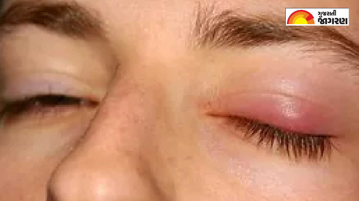 home remedies જાણો ક્યા કારણોસર આંખોમાં સોજો આવે છે, કરો આ ઘરગથ્થુ