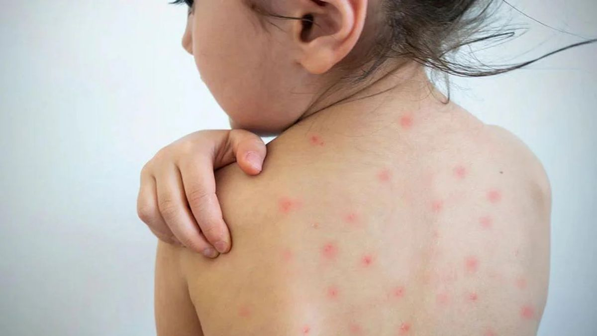 Measles Cases in Banaskantha: બનાસકાંઠાના ધાનેરામાં ઓરીના 9 કેસ પોઝિટિવ અને 37 શંકાસ્પદ જણાતા તંત્ર દોડતું થયું