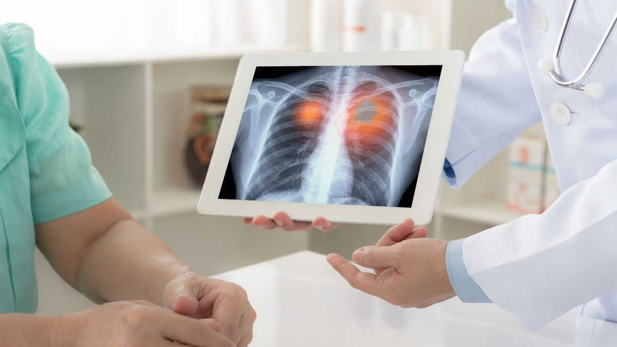 Lung Cancer: યુવાનોમાં ચિંતાજનક સ્તરે વધી રહ્યું છે ફેફસાંનું કેન્સર; લક્ષણો અને કારણો વિશે જાણો