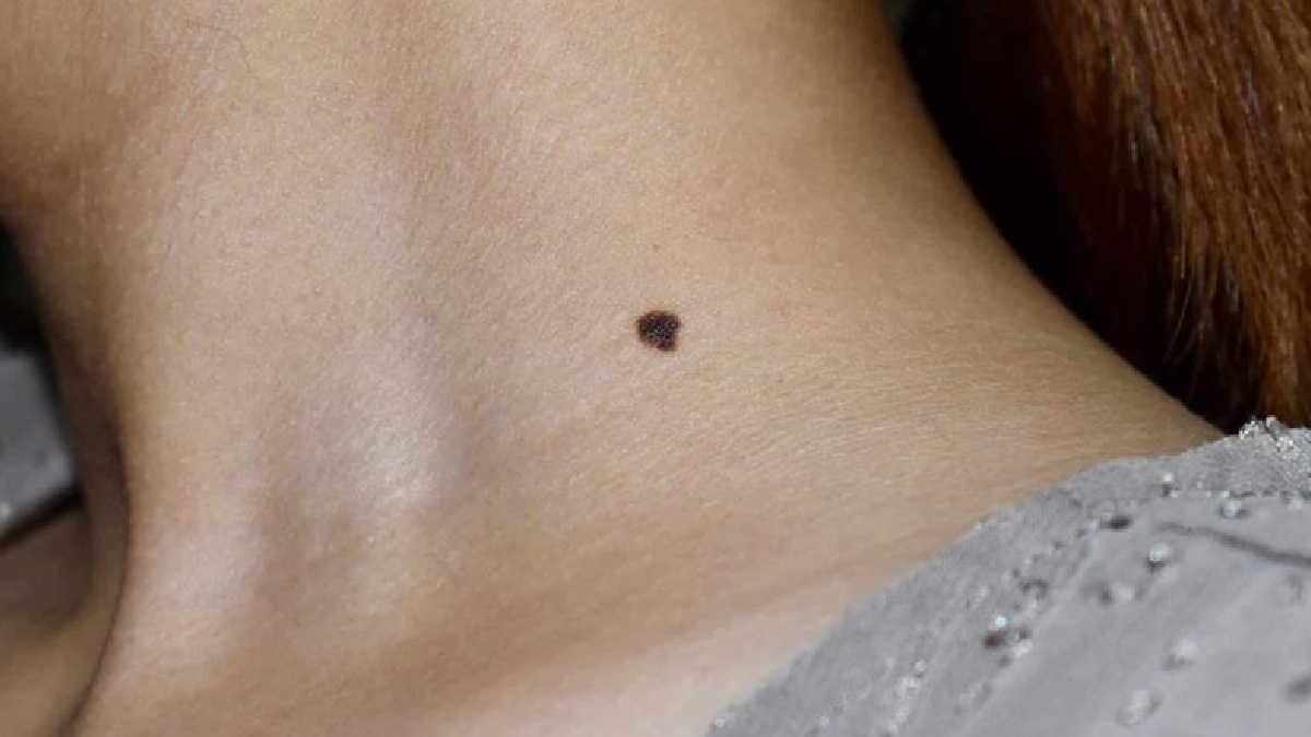 astrology-news-know-meaning-of-moles-on-neck-187406