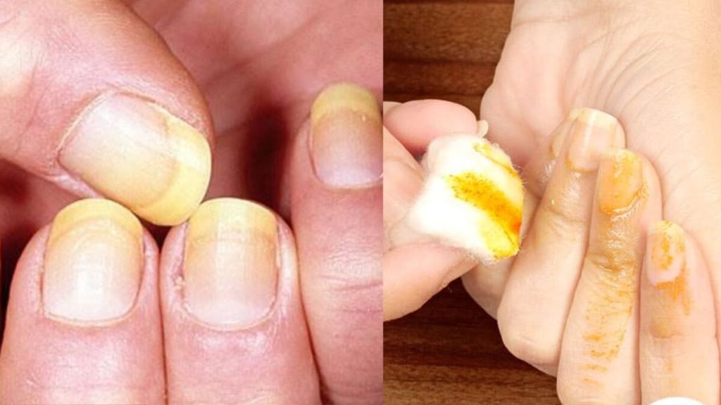 How to Remove Turmeric Stains From Nails નખ પરથી હળદરના ડાઘ ન હટતા હોય