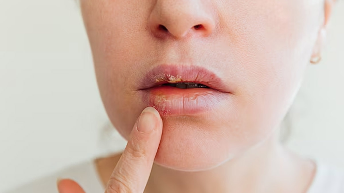 home-remedy-tips-to-cure-your-creaked-lips-in-winter-257258