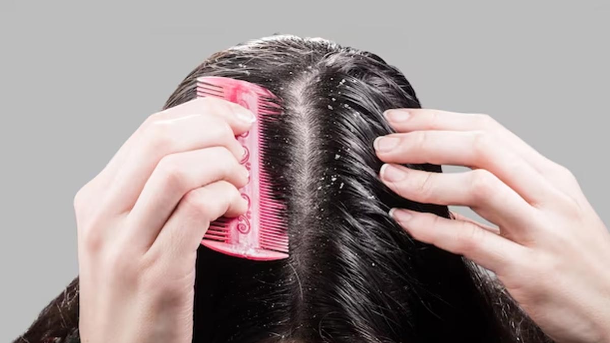 are-you-suffering-from-dandruff-problem-with-the-onset-of-winter-these-tips-will-give-you-relief-256876