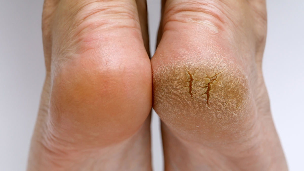 how-to-do-take-care-of-cracked-heels-at-home-253415