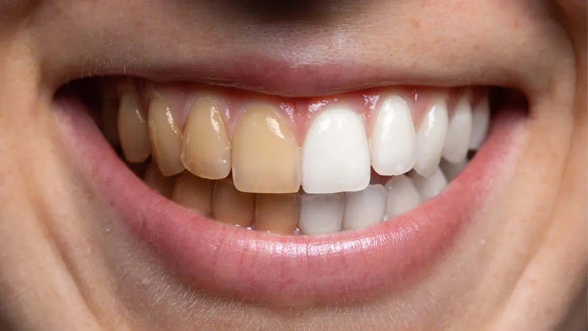 5-home-remedies-to-make-yellow-teeth-shine-like-pearls-follow-these-ayurvedic-tips-daily-593180