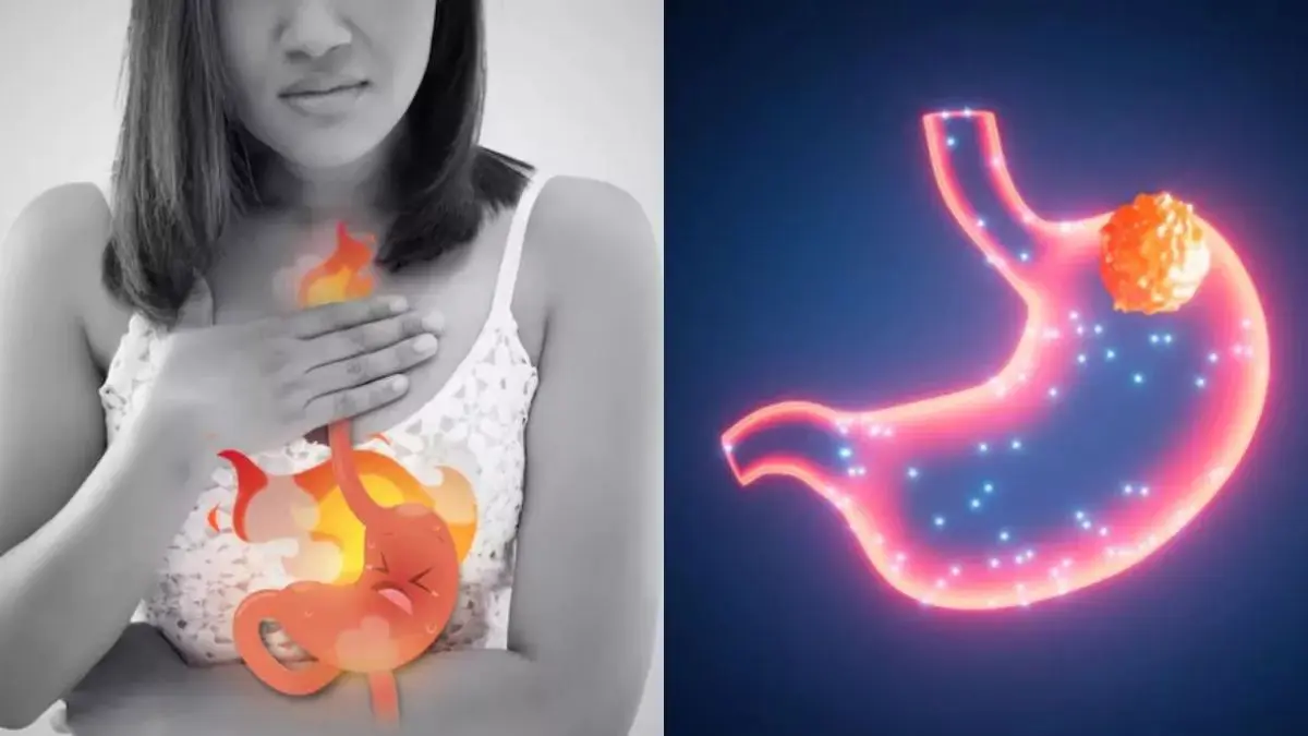 Gastric Cancer: એસિડિટી અને ખાટા ઓડકારને મામૂલી સમજવાની ભૂલ ન કરો, તે પેટના કેન્સરના શરૂઆતના સંકેતો હોઈ શકે છે