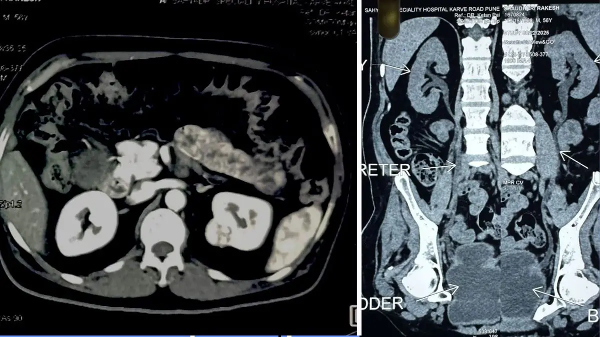 ahmedabad-civil-doctors-remove-kidney-cancer-tumor-via-laparoscopy-623831