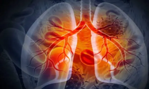 Lung cancer: ફેફસાના કેન્સર સામે મોટી સફળતા મળી, વૈજ્ઞાનિકોએ ટ્યુમરનું કદ 80 ટકા સુધી ઘટાડી શકાય તેવી પદ્ધતિ શોધી
