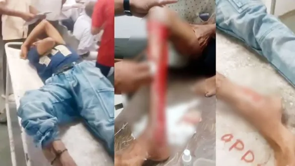 jamnagar-news-acid-attack-on-two-brothers-in-sachana-village-local-crime-news