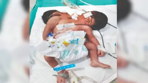 odisha-baby-two-heads-three-arms-rare-conjoined-twins-parapagus-case