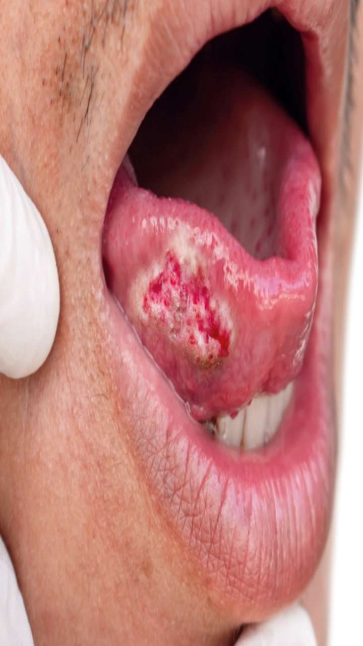 Oral Cancer: મોઢાનું કેન્સર કેવી રીતે થાય છે?