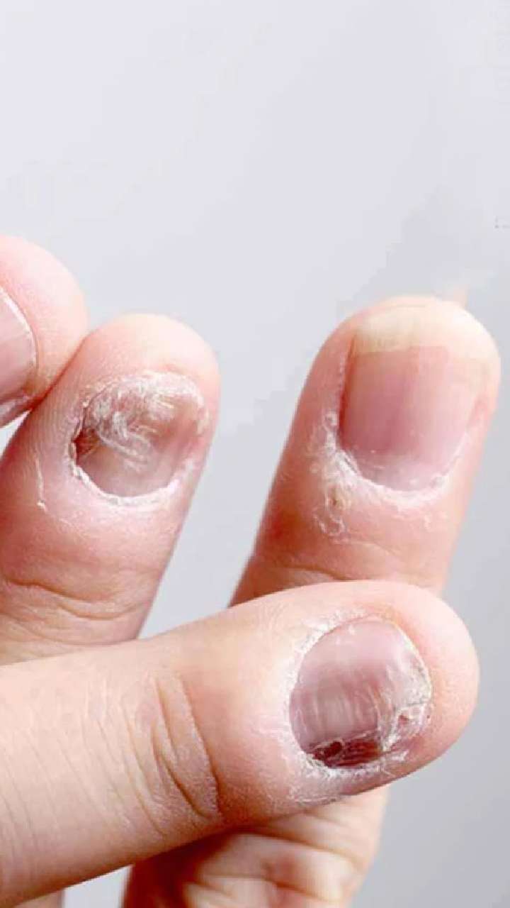 Suffering from dark skin around nails! Know the causes and remedies |  TheHealthSite.com